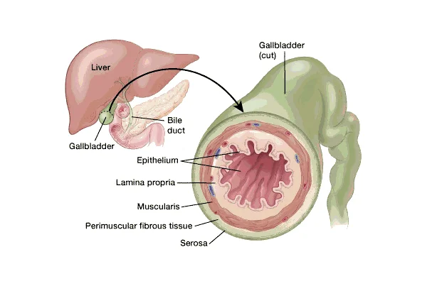 Carcinoma GallBladder