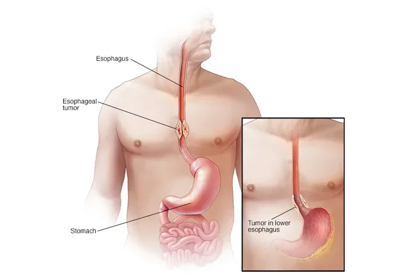 Esophagus