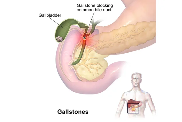Gallstones