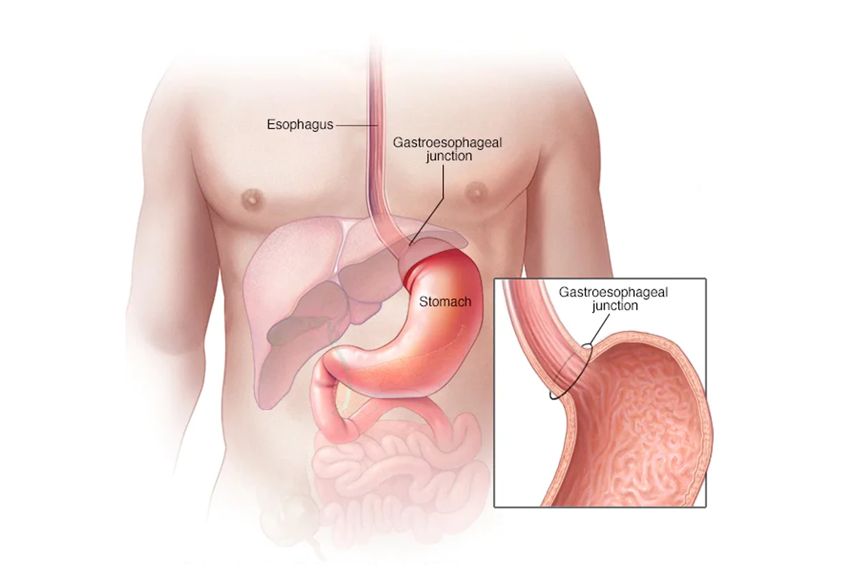 Stomach Cancer
